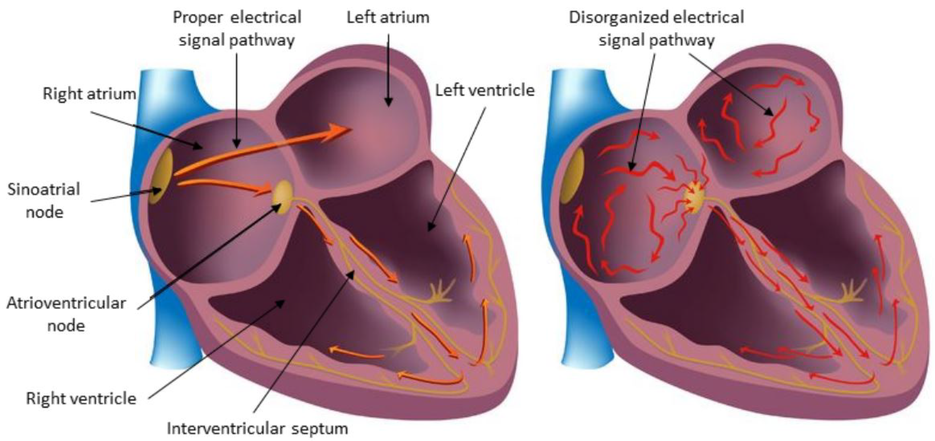 Предсердие болезни. Мерцательная аритмия сердца. Мерцательная аритмия и фибрилляция предсердий. Attrial Fibrilation. Фибрилляция сердца.