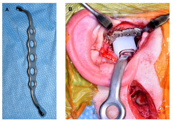 Concomitant Temporomandibular Joint Replacement and