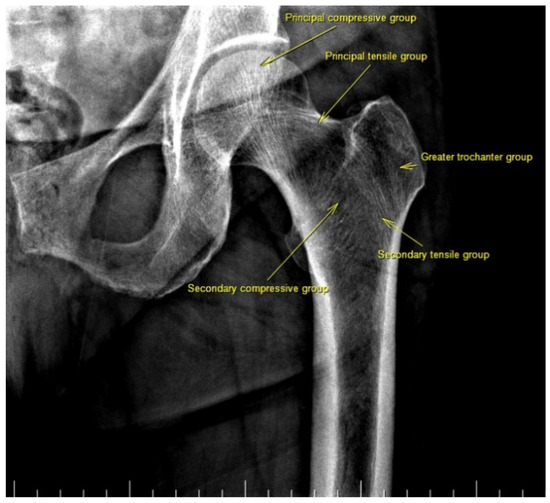 Evaluation of the Relationship between Osteoporosis Parameters in Plain ...