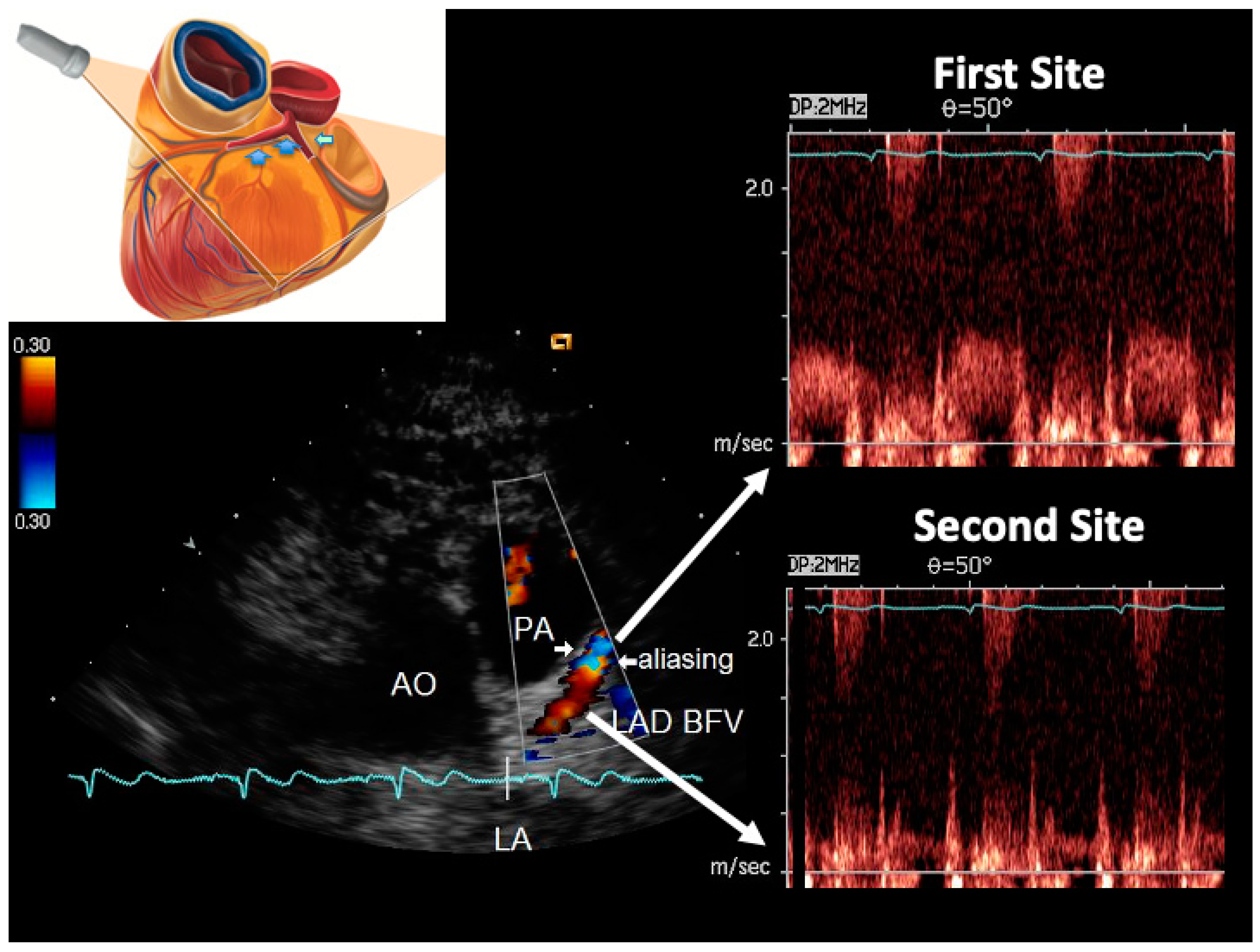 Stress Echocardiogram With Doppler Color Flow Cpt Code