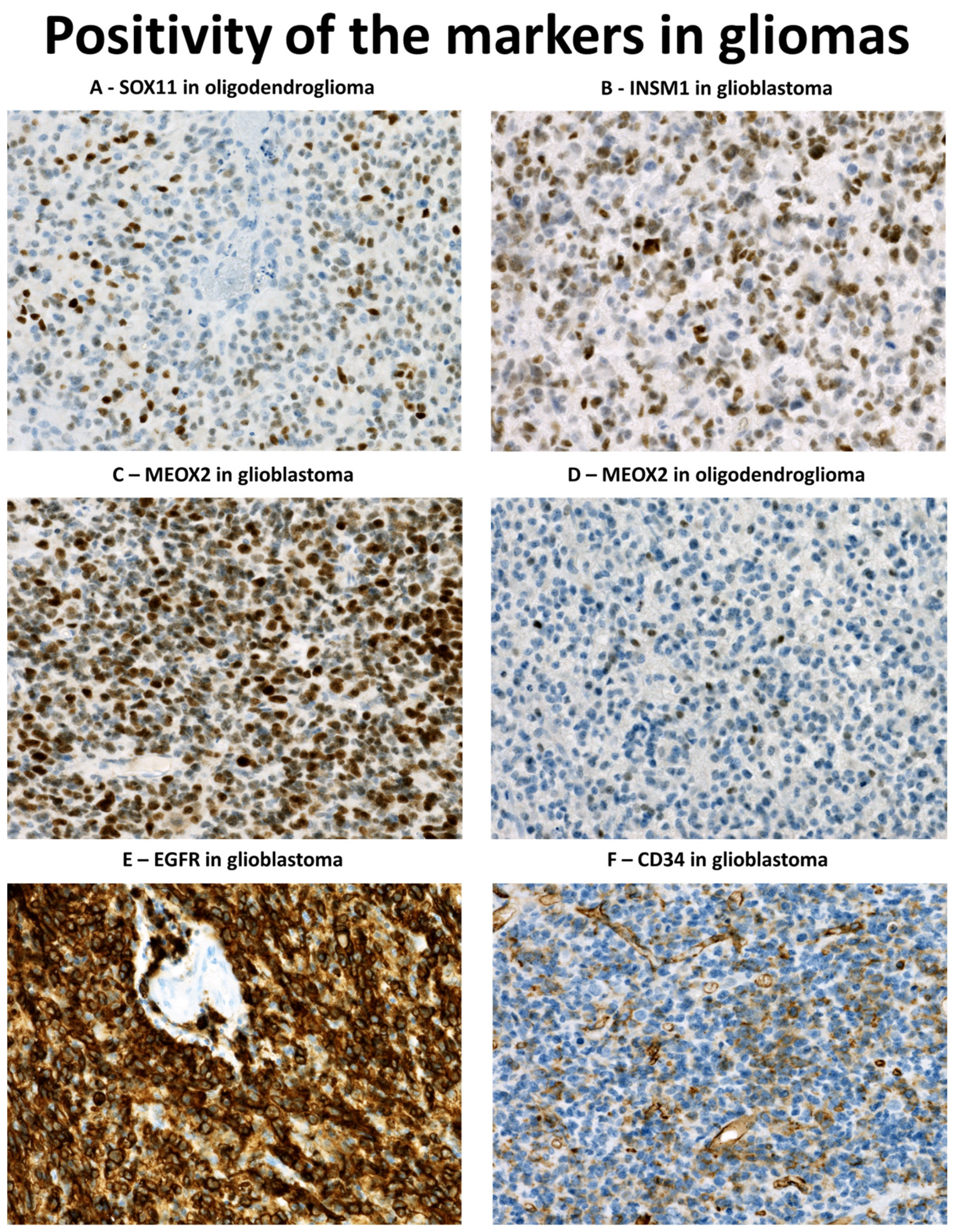 Diagnostic Utility of Immunohistochemical Detection of MEOX2
