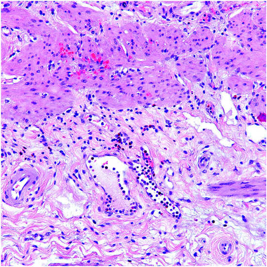 Diagnostics Free FullText Eosinophilic Cholecystitis and Eosinophils in Gallbladder