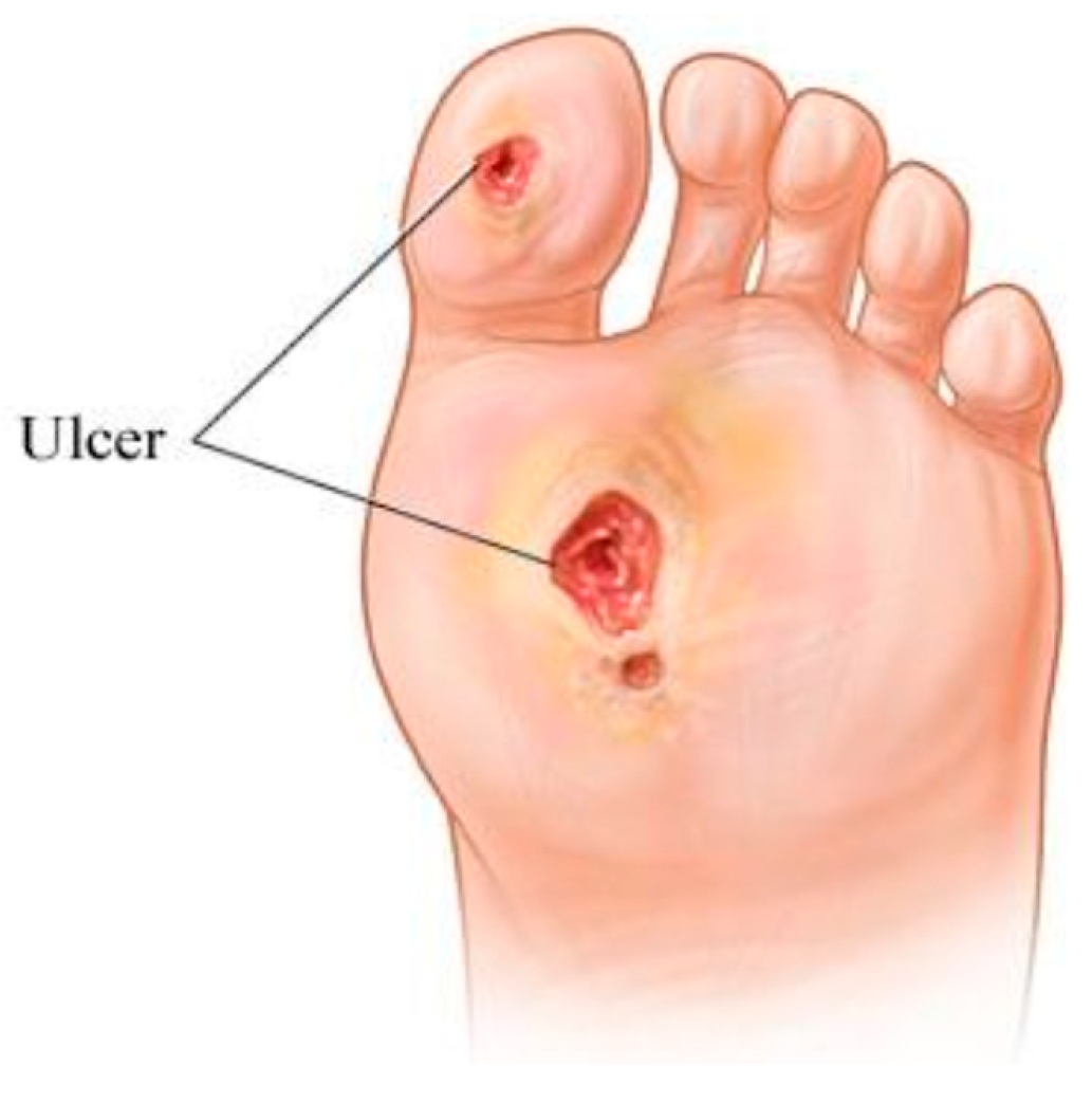 Diabetic Foot Ulcers: The Most Common Cause of Hospitalization Among  Diabetics