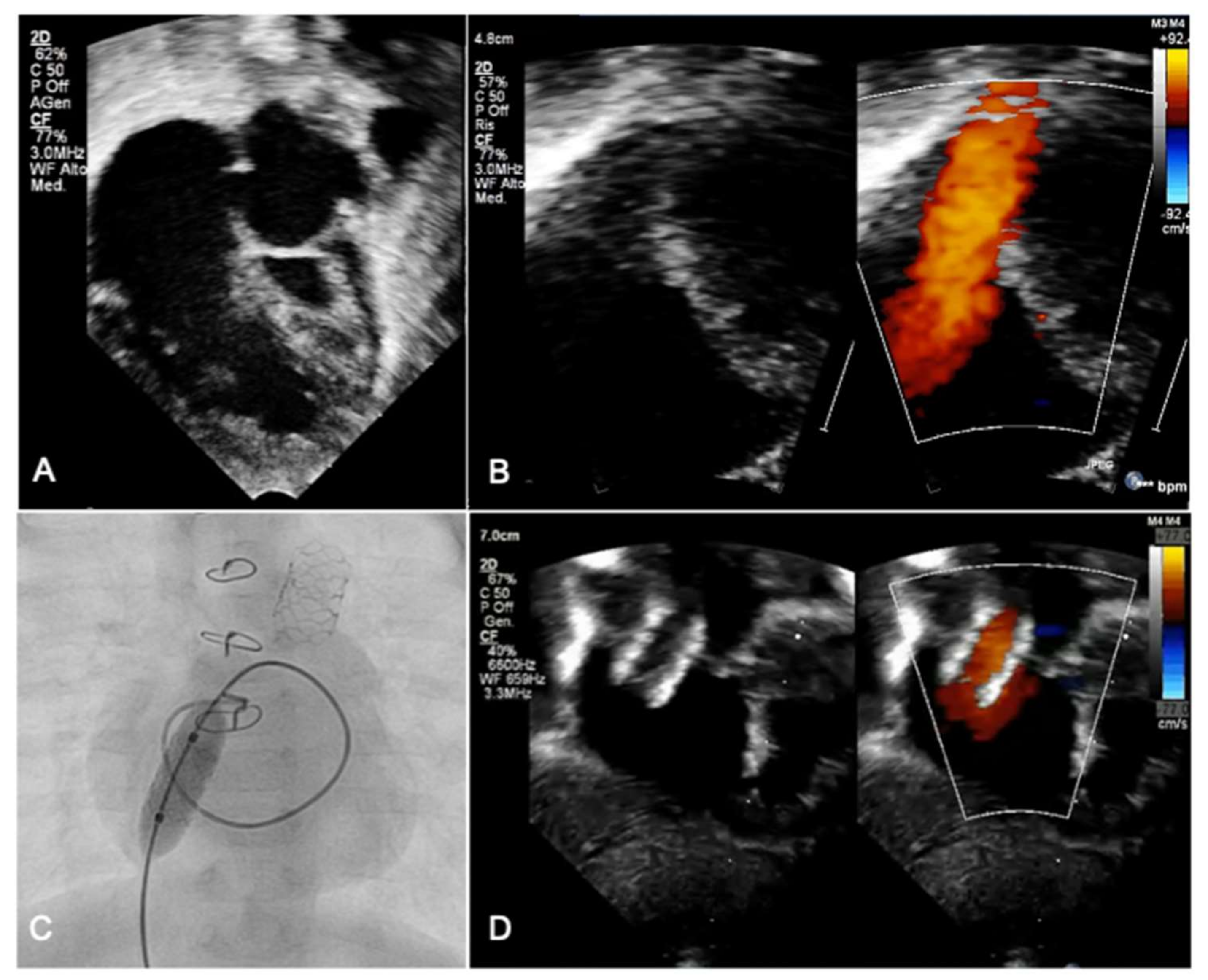 Transcatheter Interventions for Neonates with Congenital Heart 