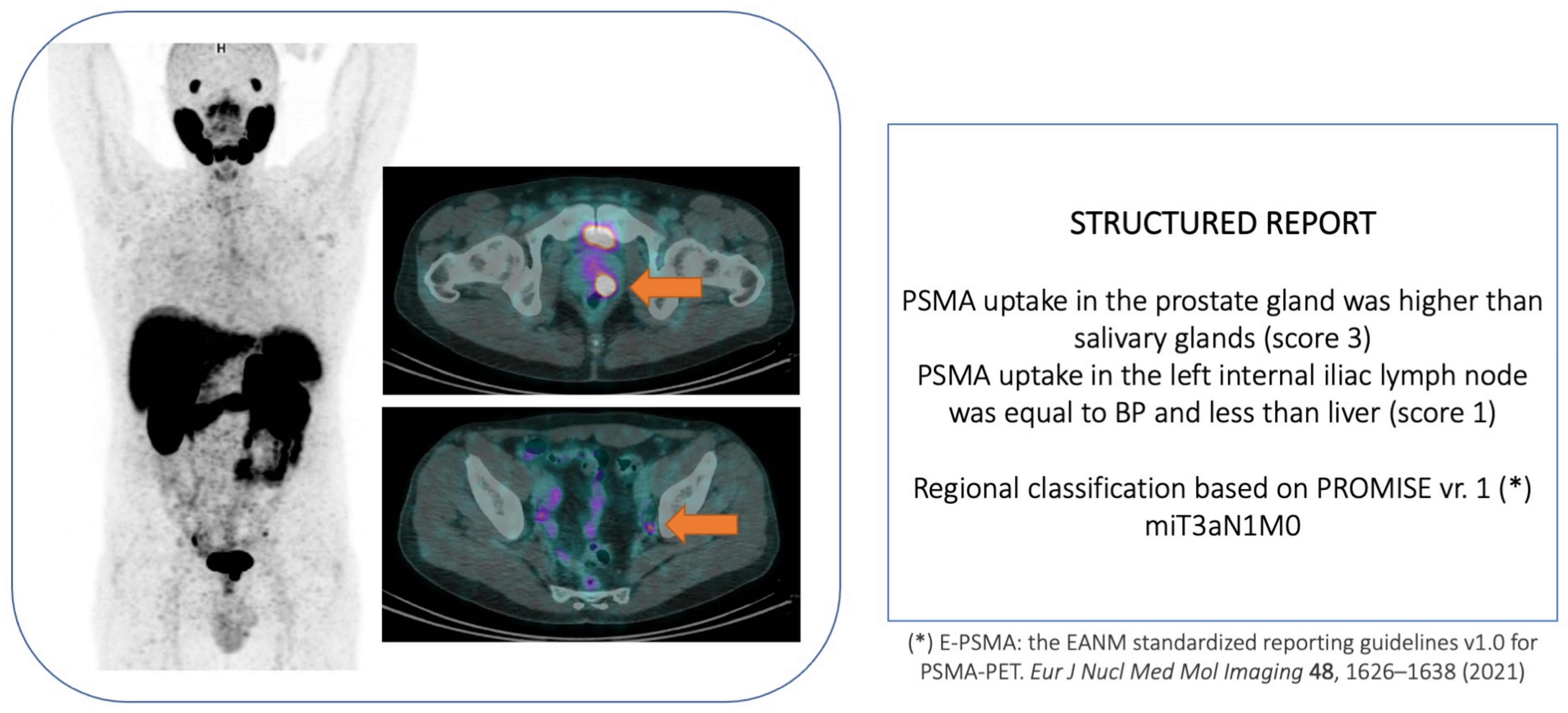 What To Do With a Positive PSMA PET and Negative Conventional Imaging in  Patients With Prostate Cancer