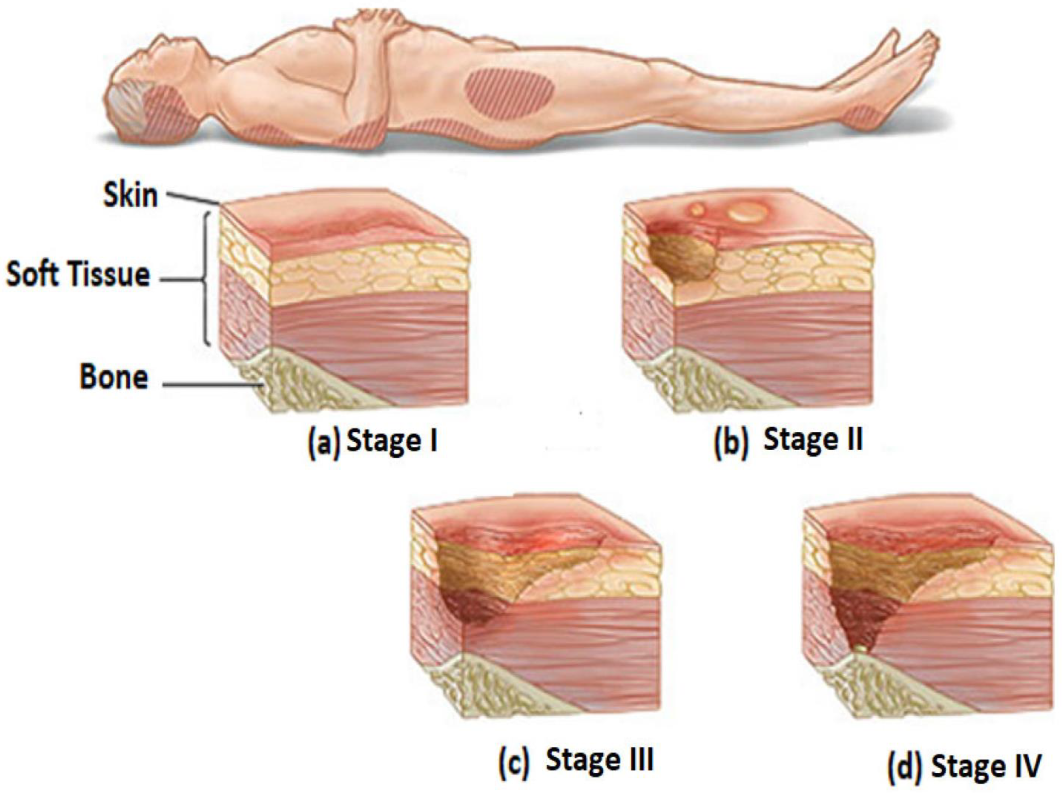Systematic Review for Risks of Pressure Injury and Prediction 