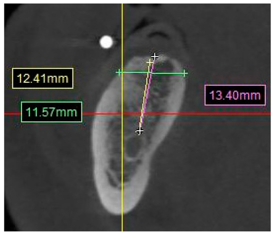 Reliability of Cone Beam Computed Tomography in Predicting Implant ...