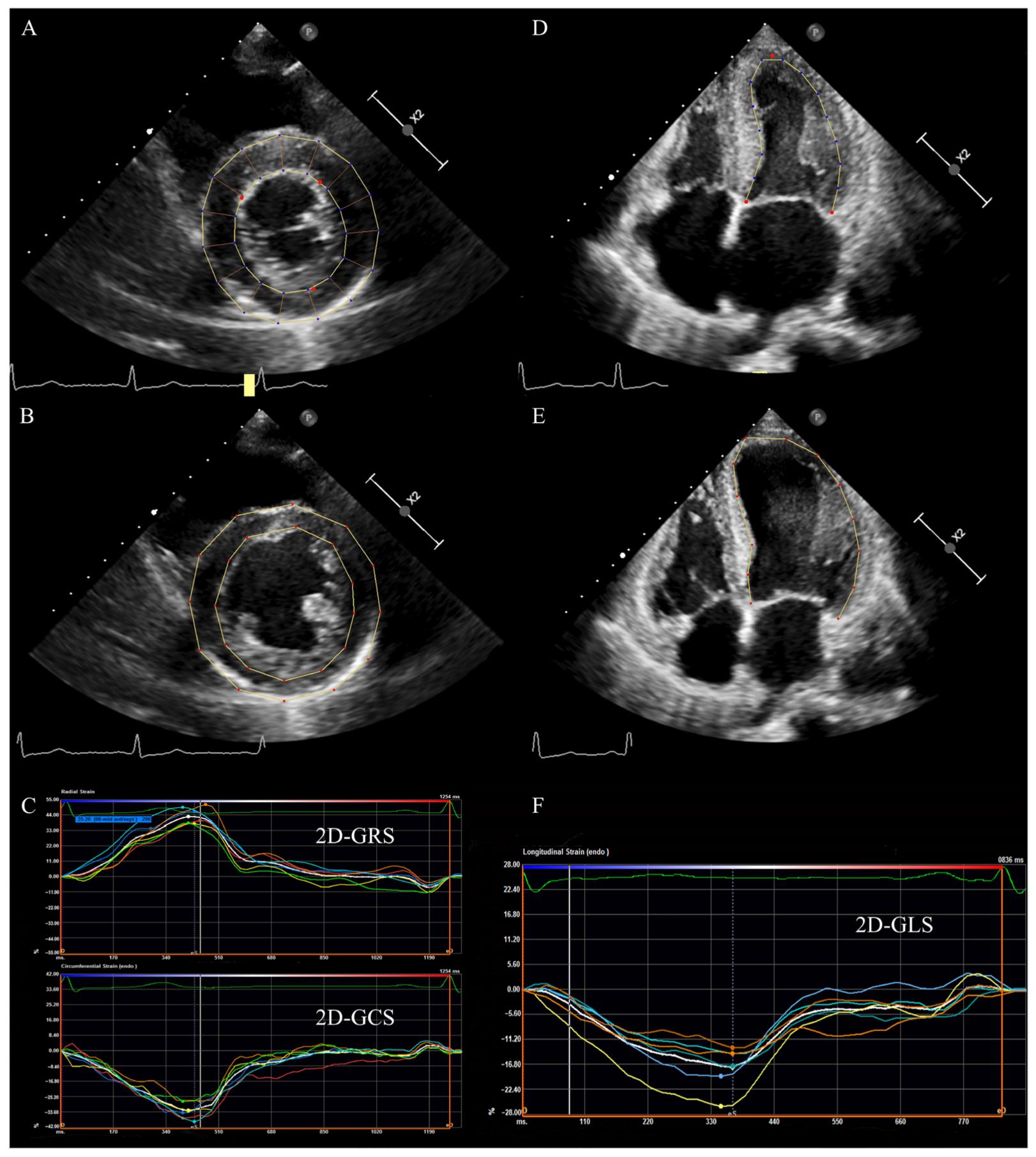 The value of 2D speckle-tracking strain echocardiography in evaluating the  relationship between carotid elasticity and left ventricular systolic  function in patients with diabetic nephropathy, Insights into Imaging