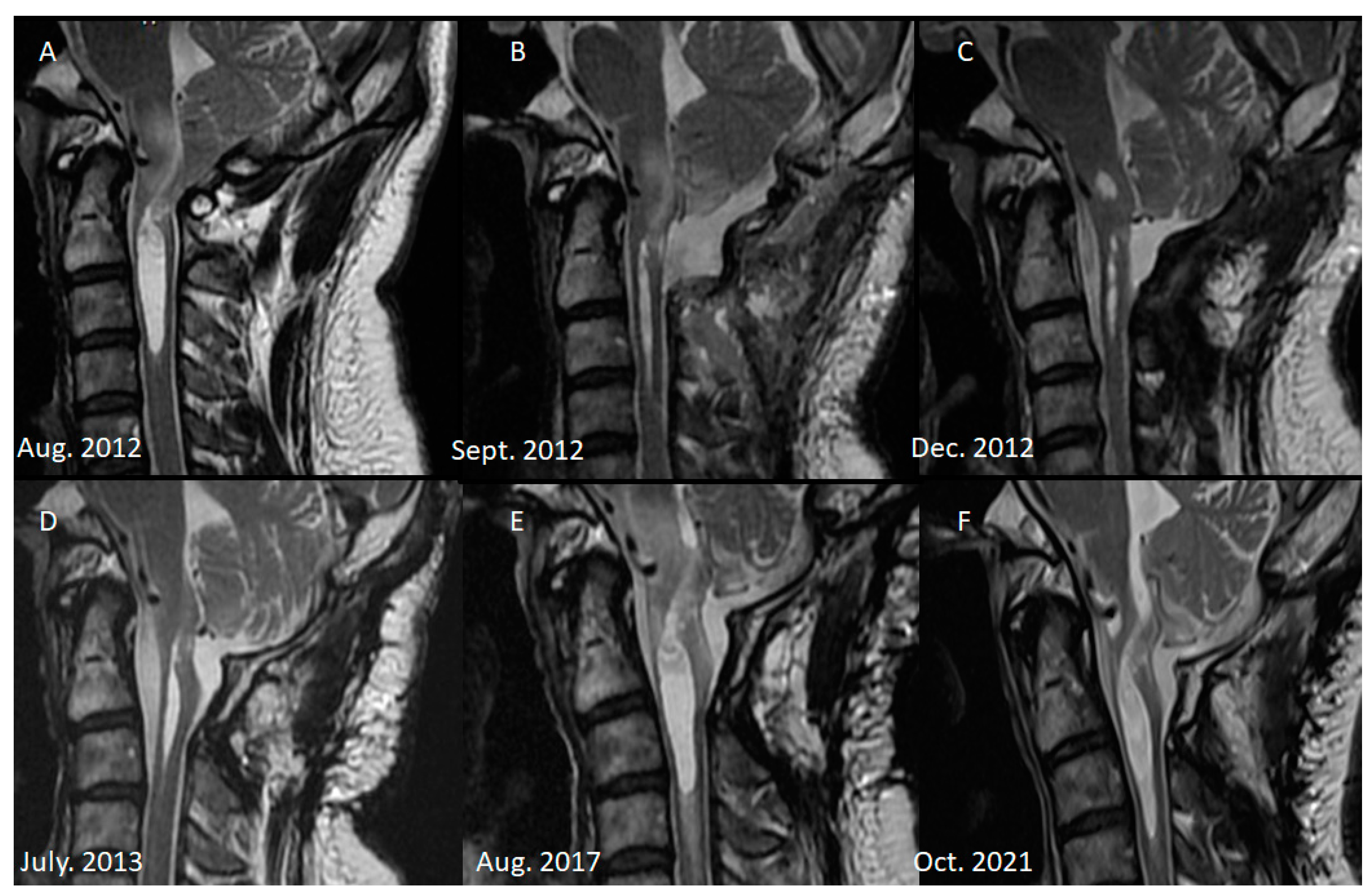 Diagnostics | Free Full-Text | Delta Cord as a Radiological Localization  Sign of Postoperative Adhesive Arachnoiditis: A Case Report and Literature  Review
