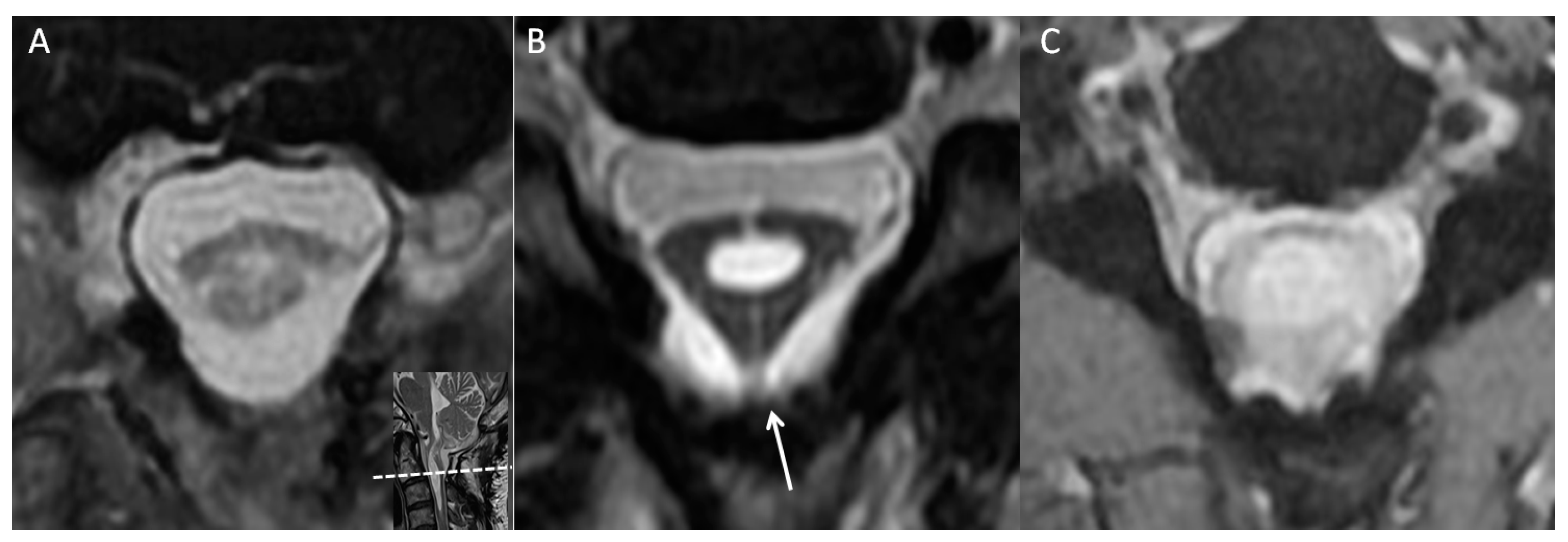 Diagnostics | Free Full-Text | Delta Cord as a Radiological Localization  Sign of Postoperative Adhesive Arachnoiditis: A Case Report and Literature  Review