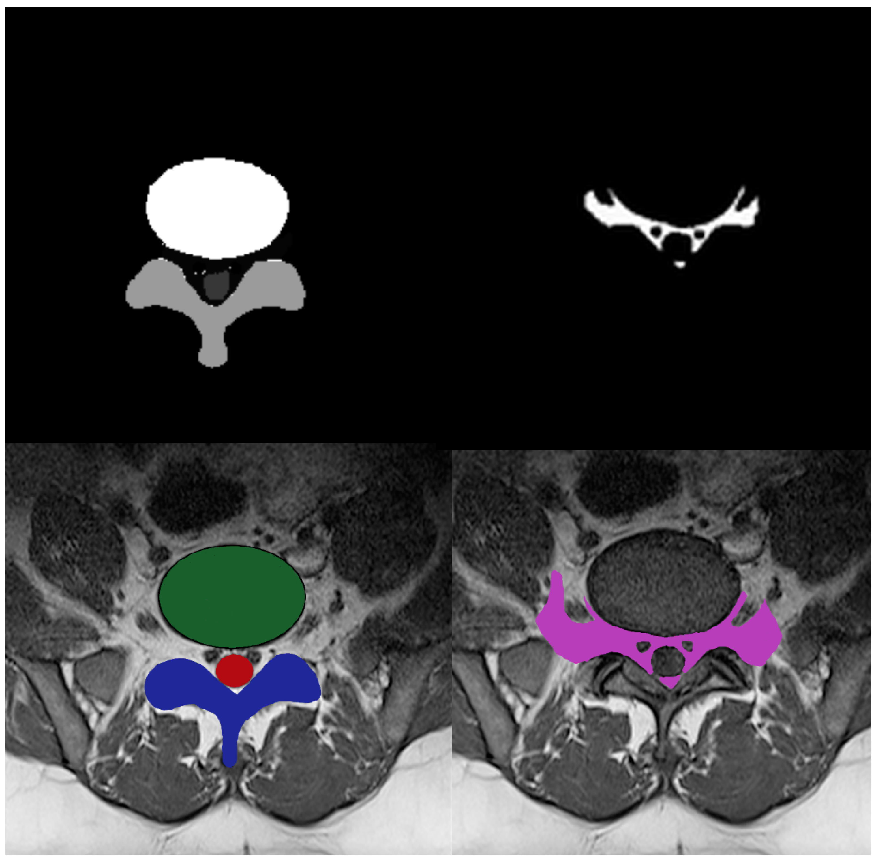Diagnostics Free FullText Nerve Root Compression Analysis to Find Lumbar Spine Stenosis on