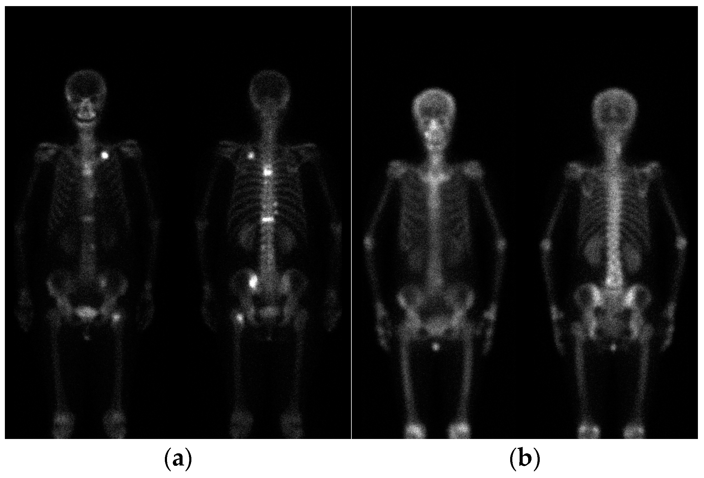 Diagnostics free full text bone metastases lesion segmentation on