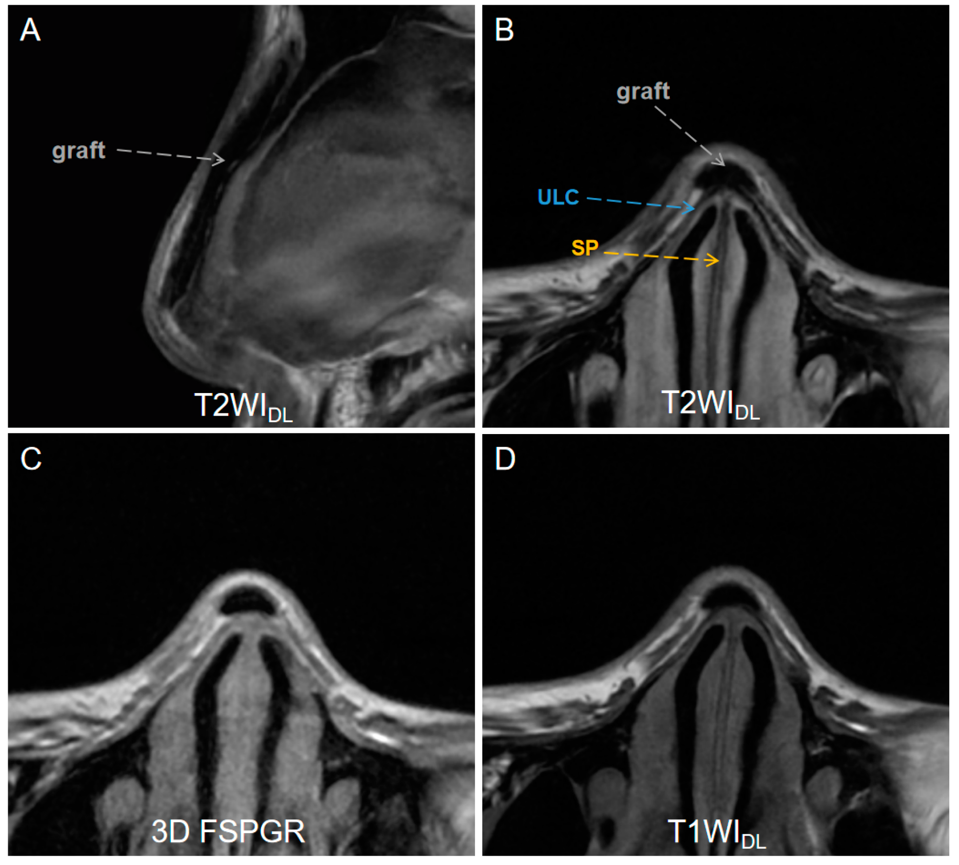 Usefulness of T2-Weighted Images with Deep-Learning-Based
