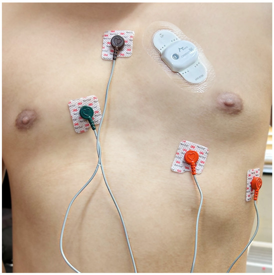Diagnostics Free FullText Comparison of the 11Day Adhesive ECG Patch Monitor and 24h