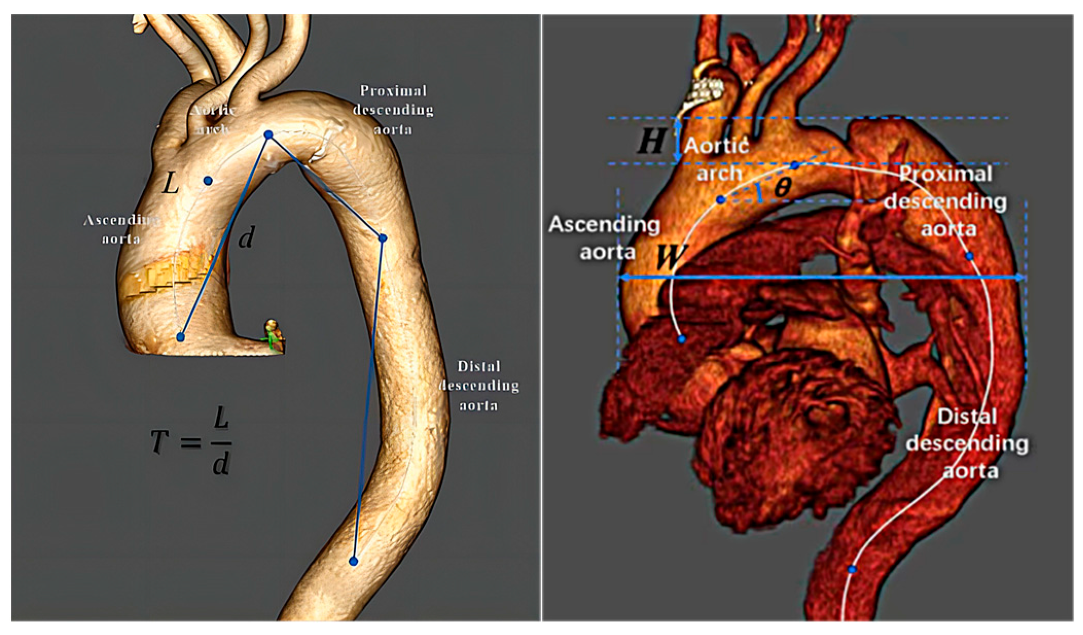 Ascending and descending aorta