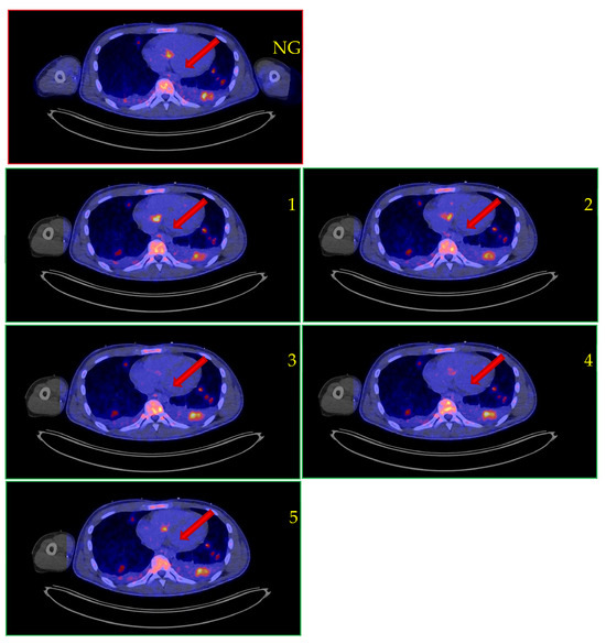 Improved [18F]FDG PET/CT Diagnostic Accuracy for Infective Endocarditis ...