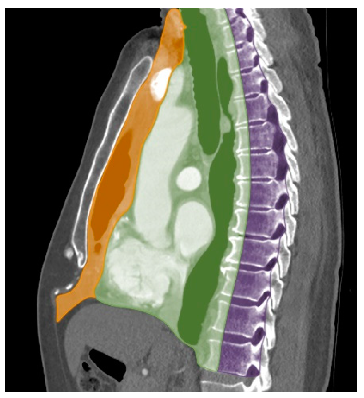 Lateral triangular space  Radiology Reference Article