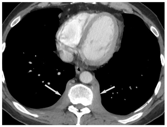 Diagnostics | Free Full-Text | Approach to Imaging of Mediastinal Masses