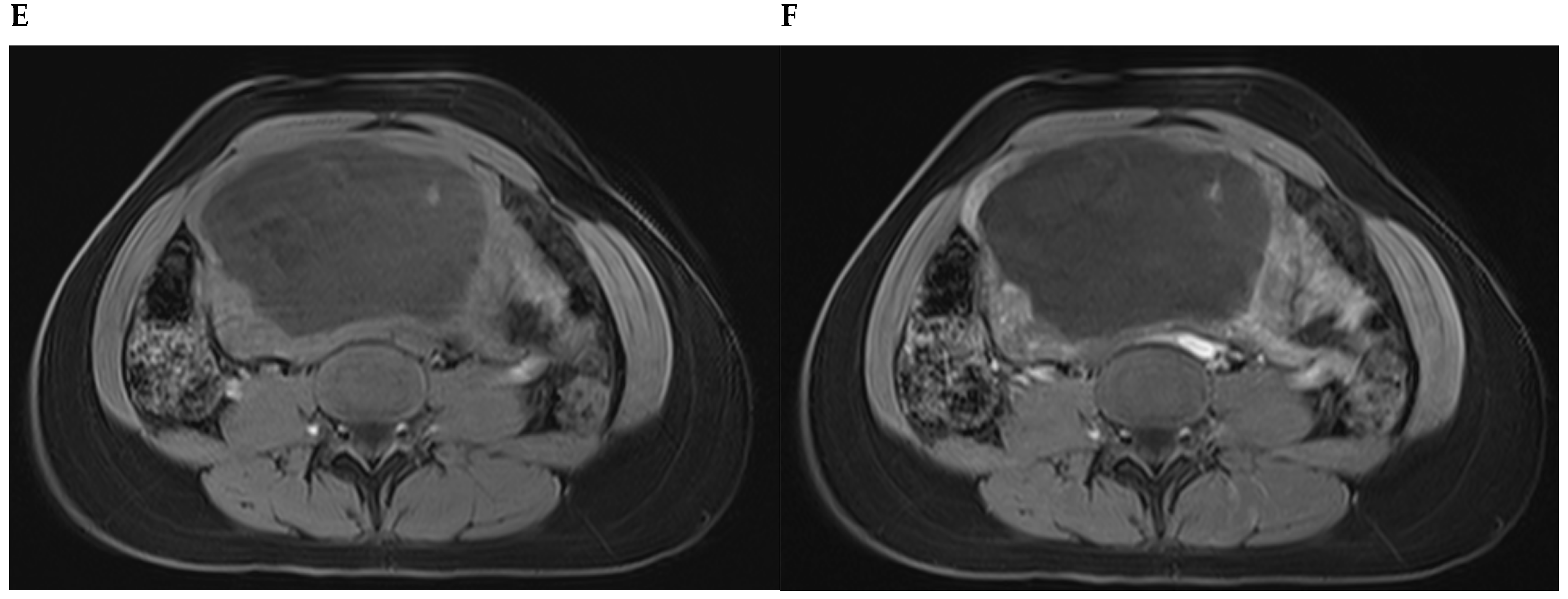 The Shocking Truth About Leiomyoma Misdiagnosis - qvbhbr6
