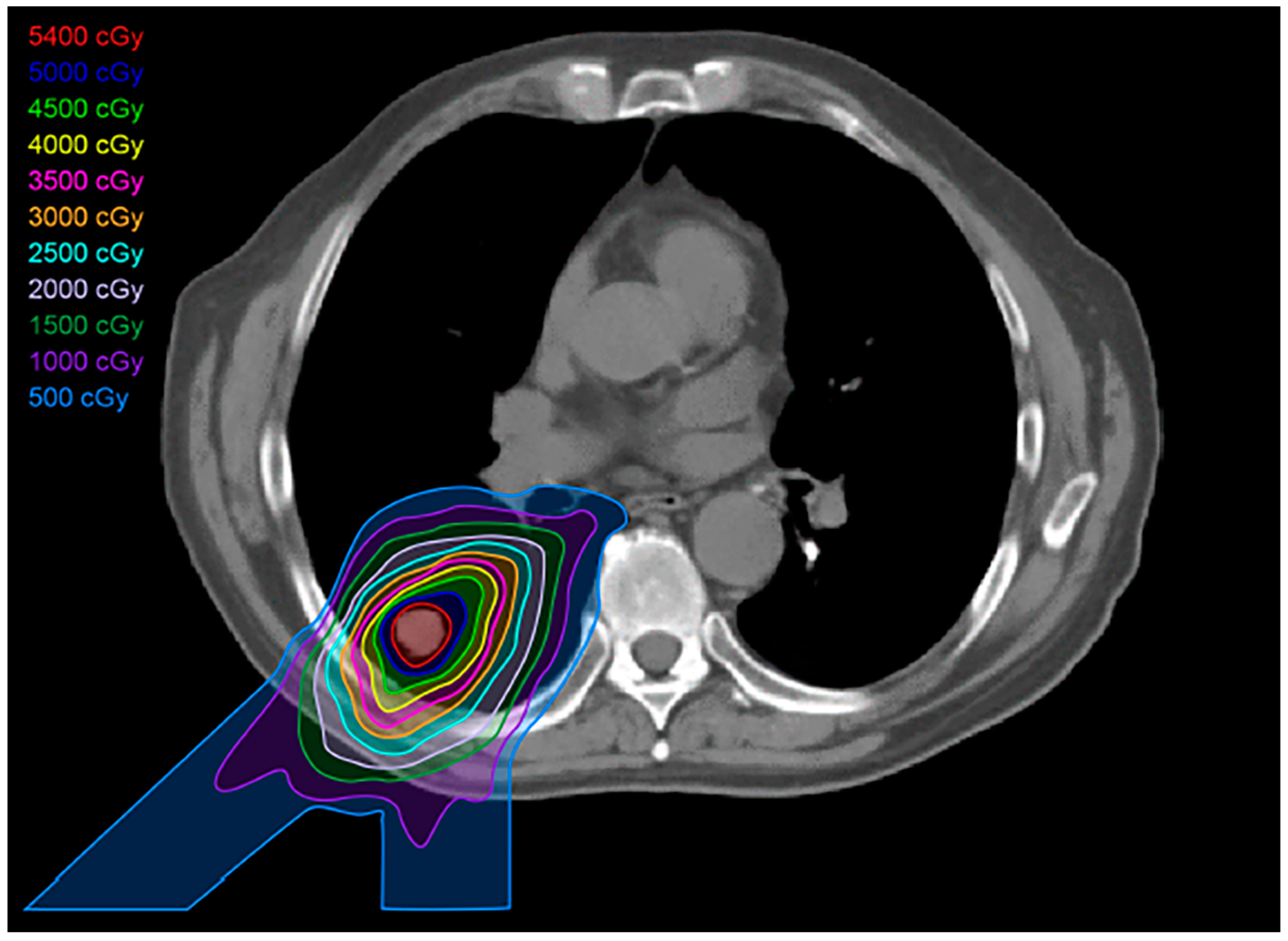 Therapeutic Bras for Radiation Therapy Treatment