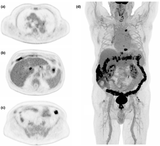 Potential Clinical Impact of LAFOV PET/CT: A Systematic Evaluation of ...