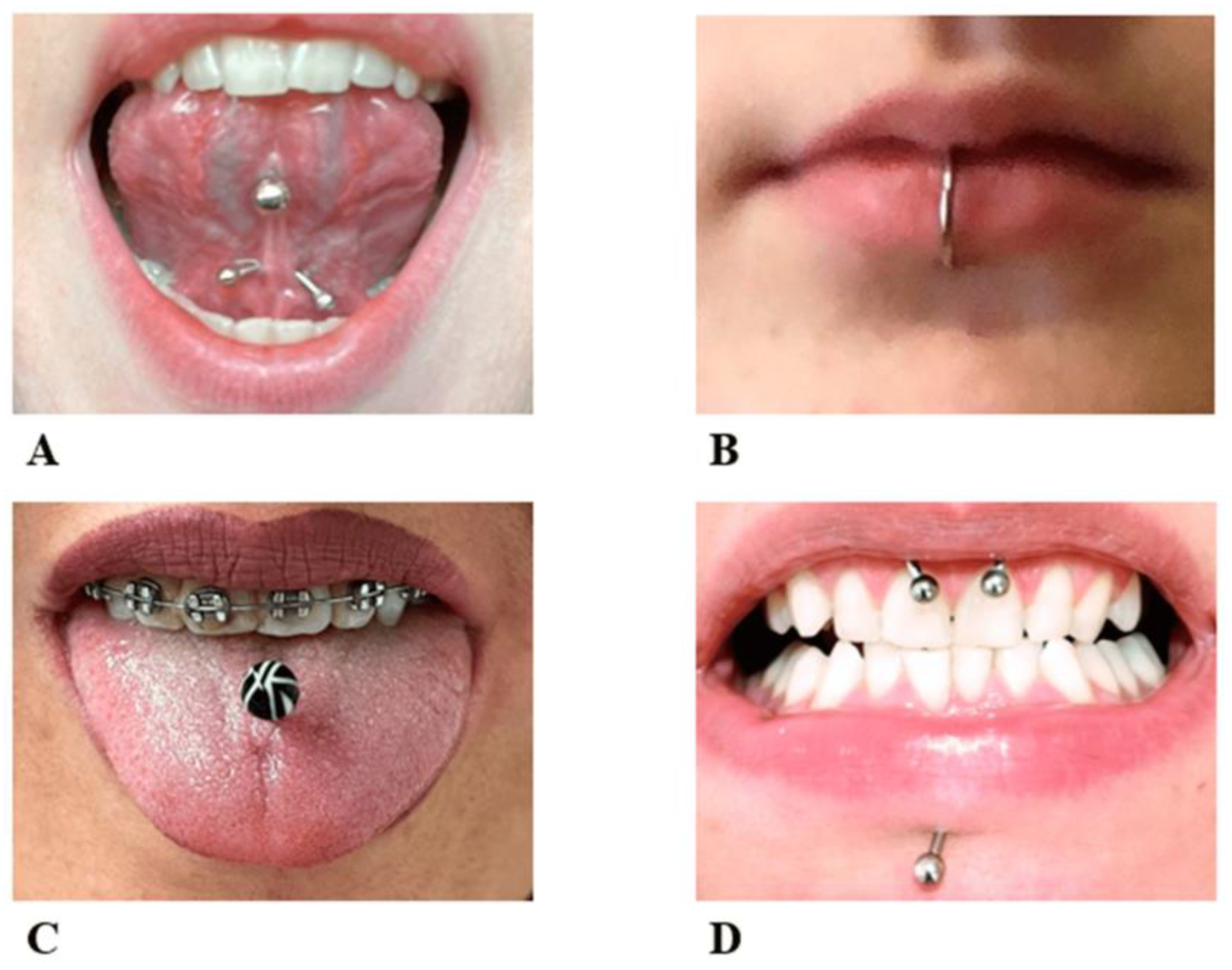 Smiley piercing: pain, healing, types of jewelry