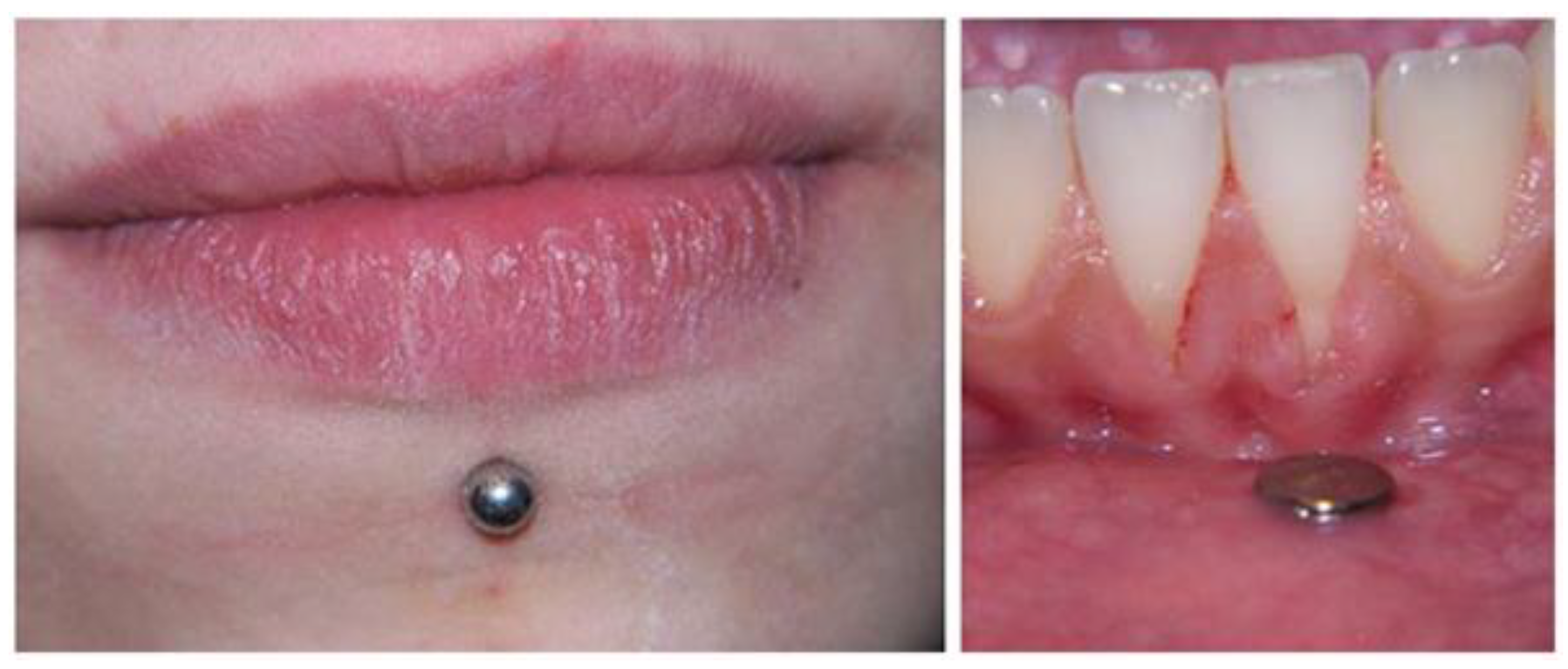 IJERPH | Free Full-Text | Oral Piercing: A Pretty Risk—A Scoping  Review of Local and Systemic Complications of This Current Widespread  Fashion