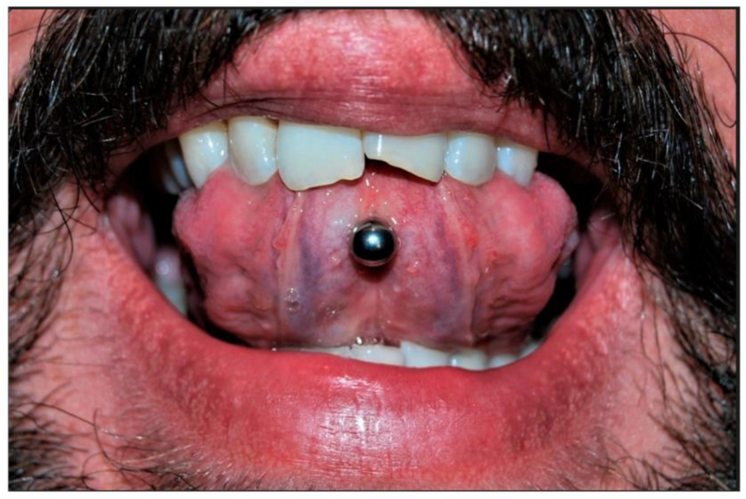 Periodontal inflammation a risk with tongue piercing