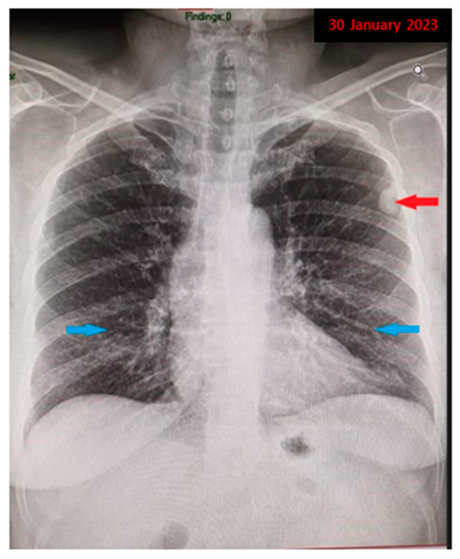 Pulmonary Amyloidoma: A Case Report and Brief Review of the Literature