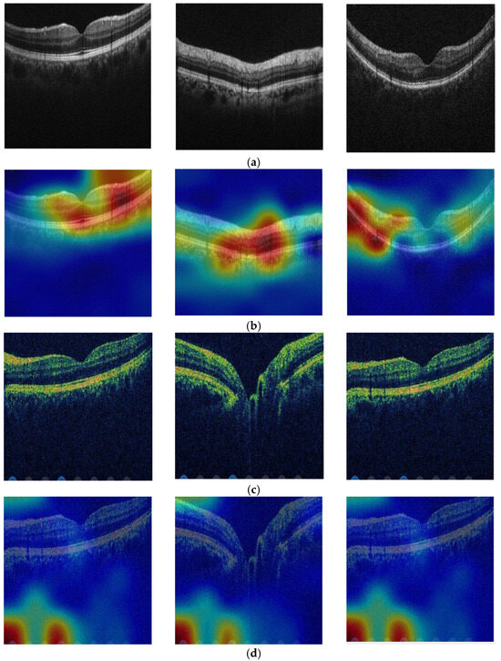 Oct Simplex Attention TurkerNeXt: Investigations into Bipolar Disorder Detection ...