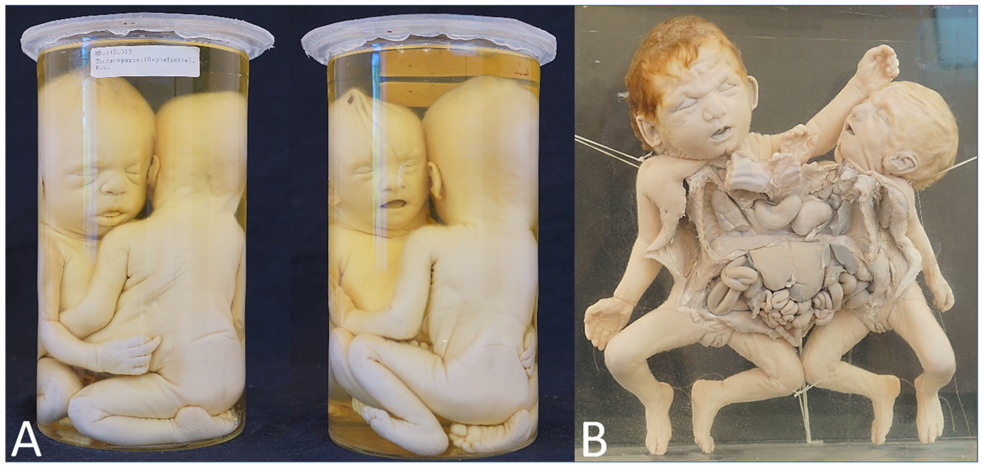 Le modèle du nouveau-né de l'Intubation - Chine Le squelette, squelette  Life-Size