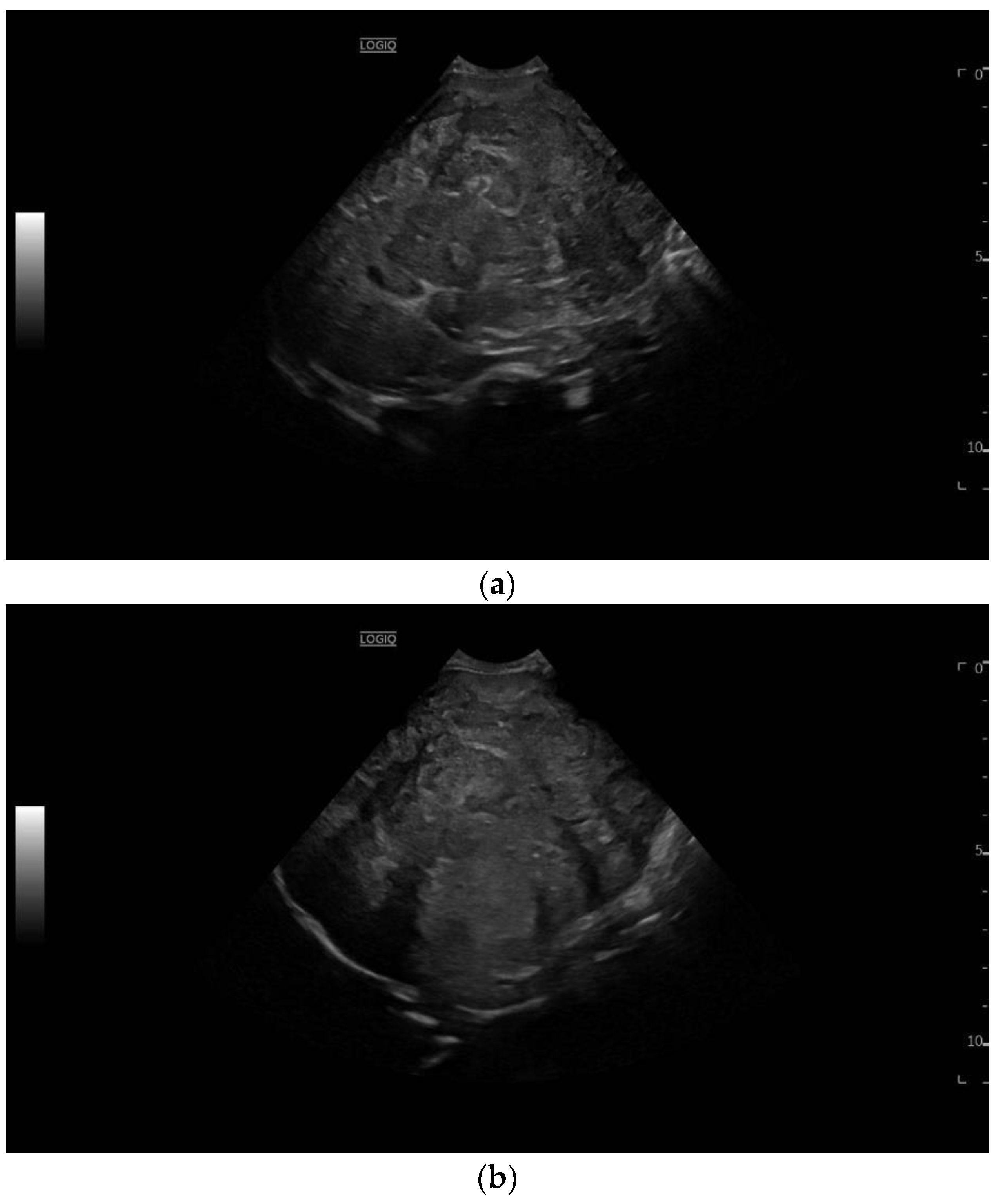 Review on Pediatric Malignant Focal Liver Lesions with Imaging 