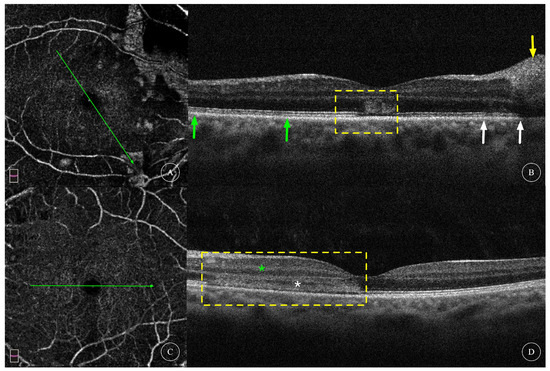 Acute Macular Neuroretinopathy after SARS-CoV-2 Infection: An Analysis ...