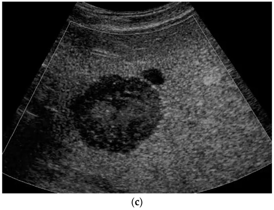 Review on Pediatric Malignant Focal Liver Lesions with Imaging