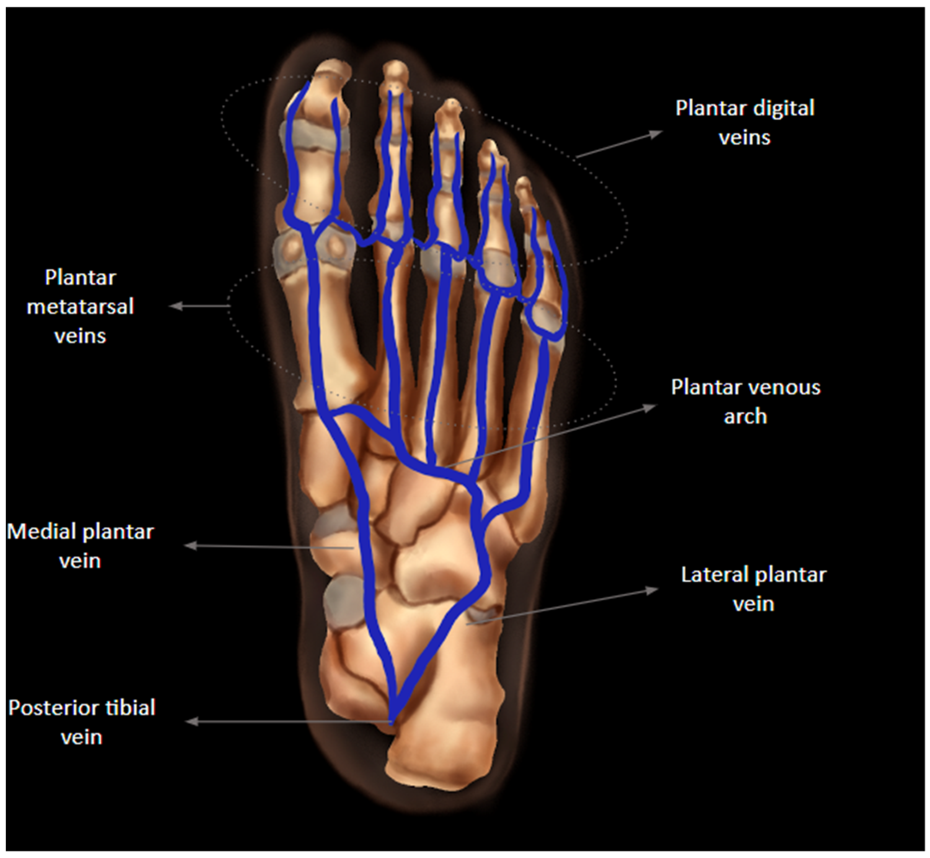 Pulsating swelling anterior-lateral aspect of the left upper leg