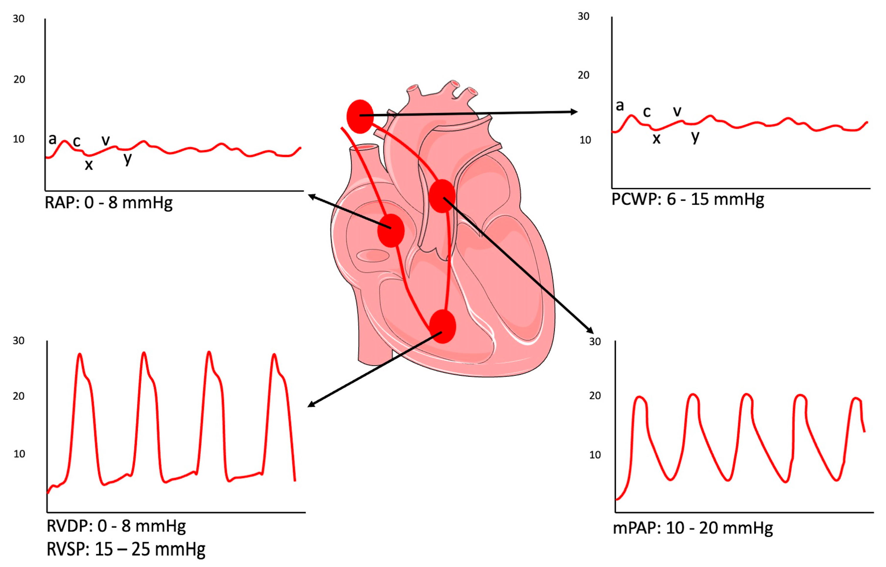 Contemporary Evidence and Practice on Right Heart Catheterization in Patients with Acute or Chronic Heart Failure
