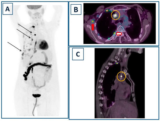 One Fell Swoop: Septic Muscle Embolism and Central Venous Catheter ...