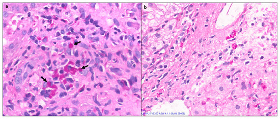 Autoimmune Hepatitis: From Evolution to Current Status—A