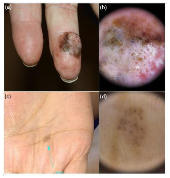 A European Multicentric Investigation of Atypical Melanocytic Skin Lesions  of Palms and Soles: The iDScore-PalmoPlantar Database