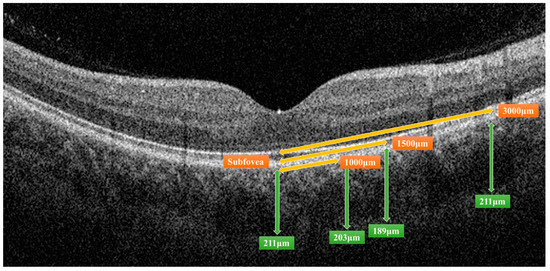 Choroidal Changes in Patients with Diabetic Retinopathy: A ...