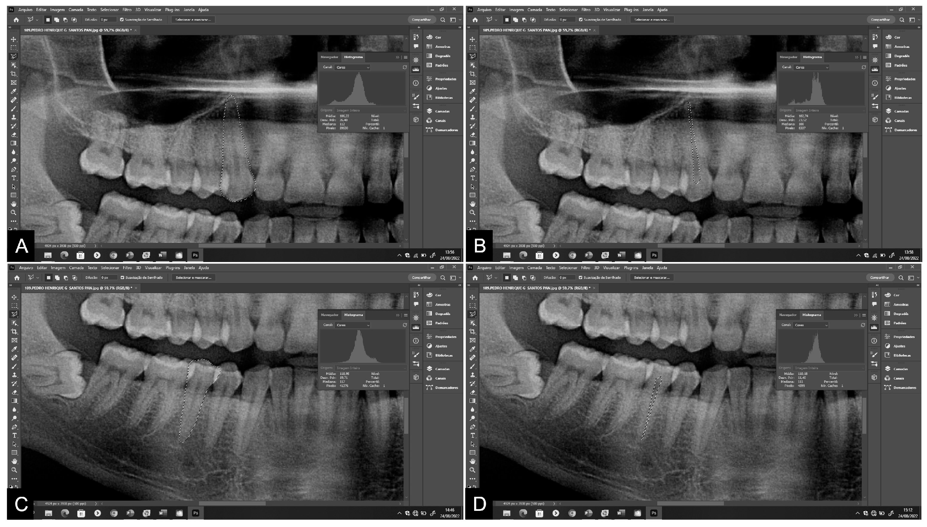 Age Estimation in Brazilian Adults Using the Pulp/Tooth Ratio of 