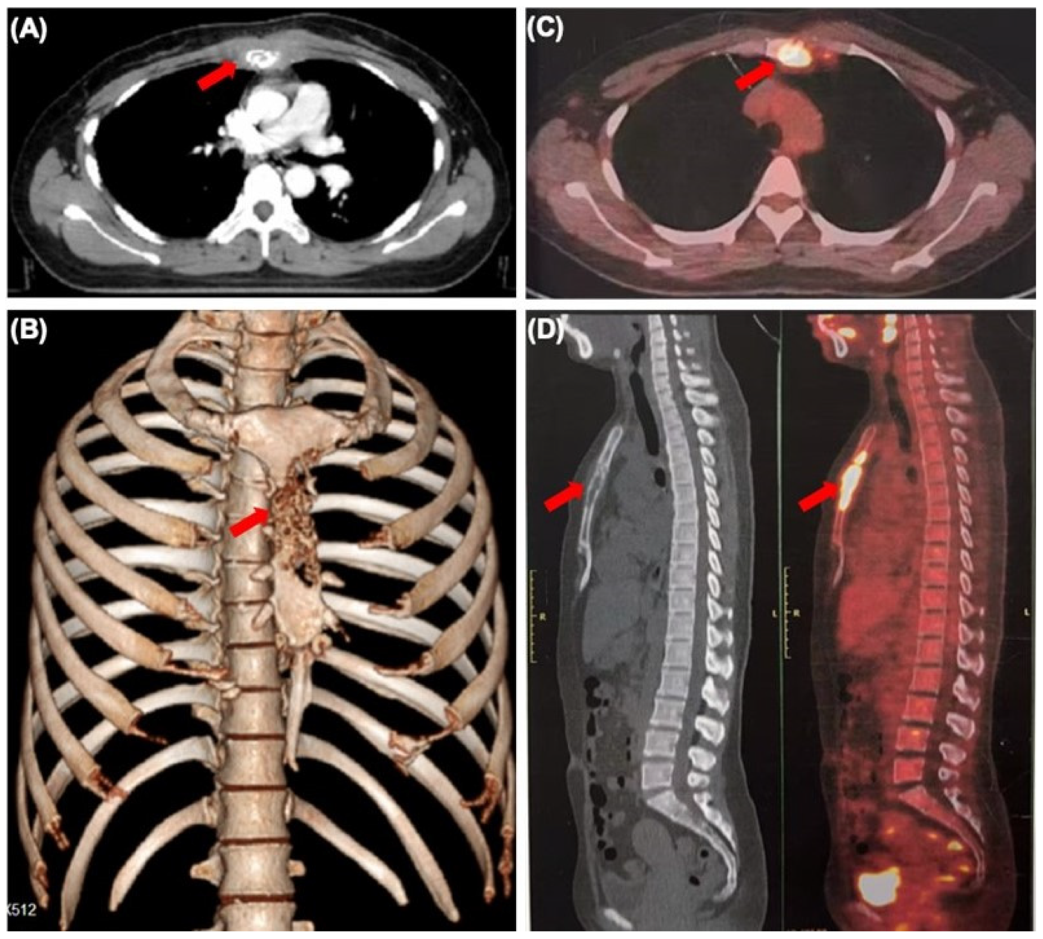 健康・医学 Breast Cancer Frontiers | Primary squamous cell carcinoma of the breast: A