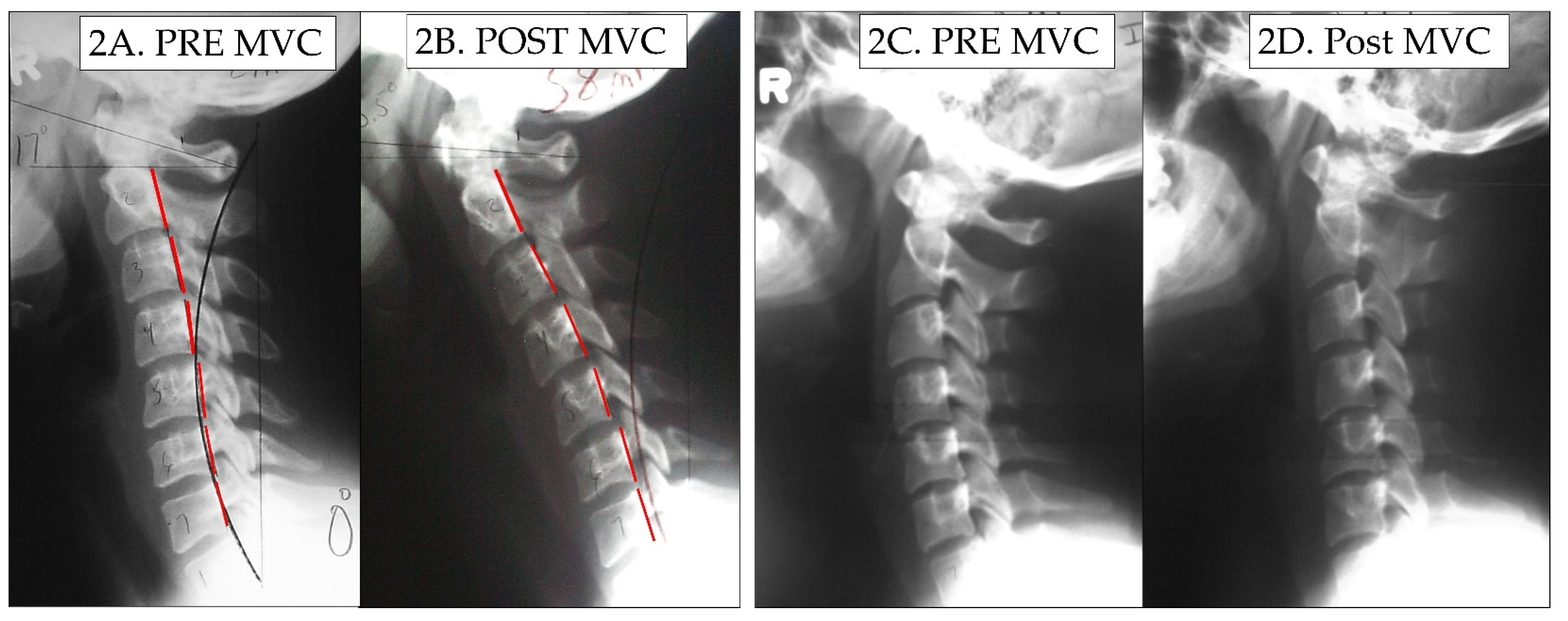 Reversal of cervical lordosis mri safety infoupdate