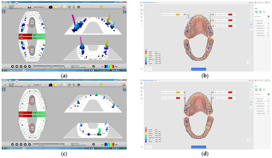健康・医学 Occlusion Reversible cerebral vasoconstriction syndrome in idiopathic