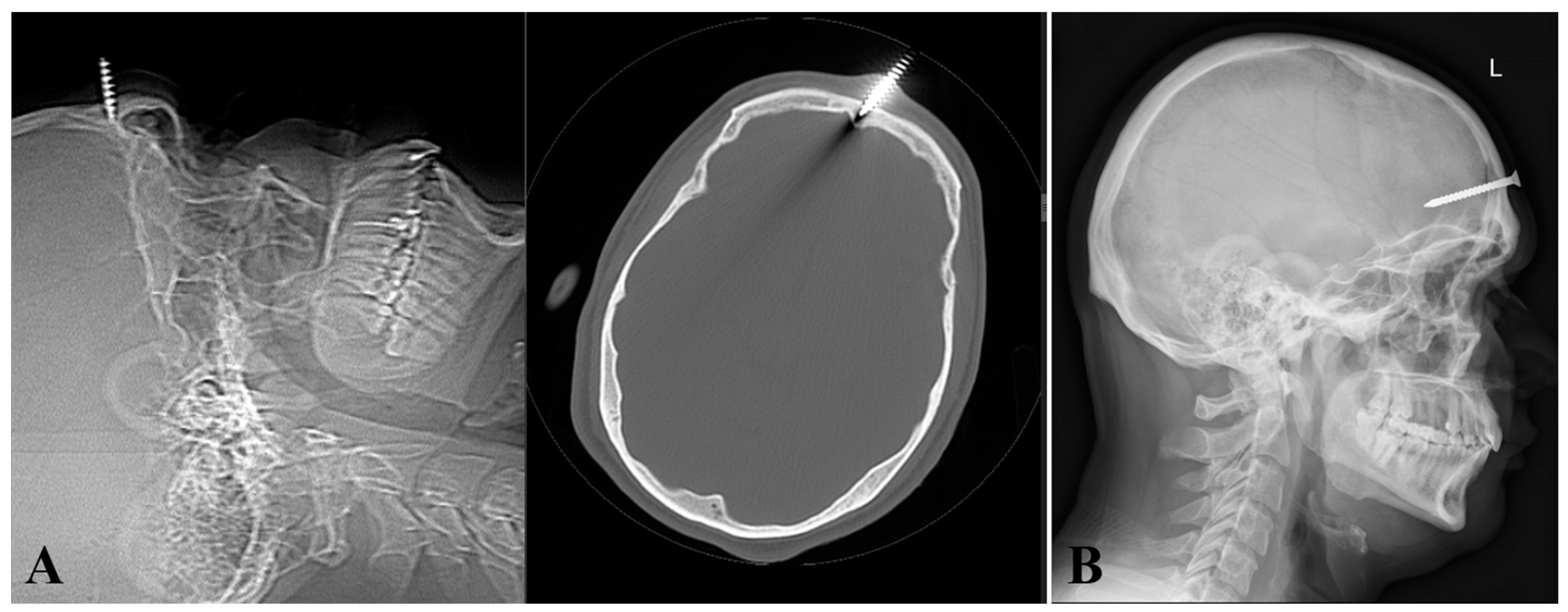 Repetitive Self-Inflicted Craniocerebral Injury in a Patient
