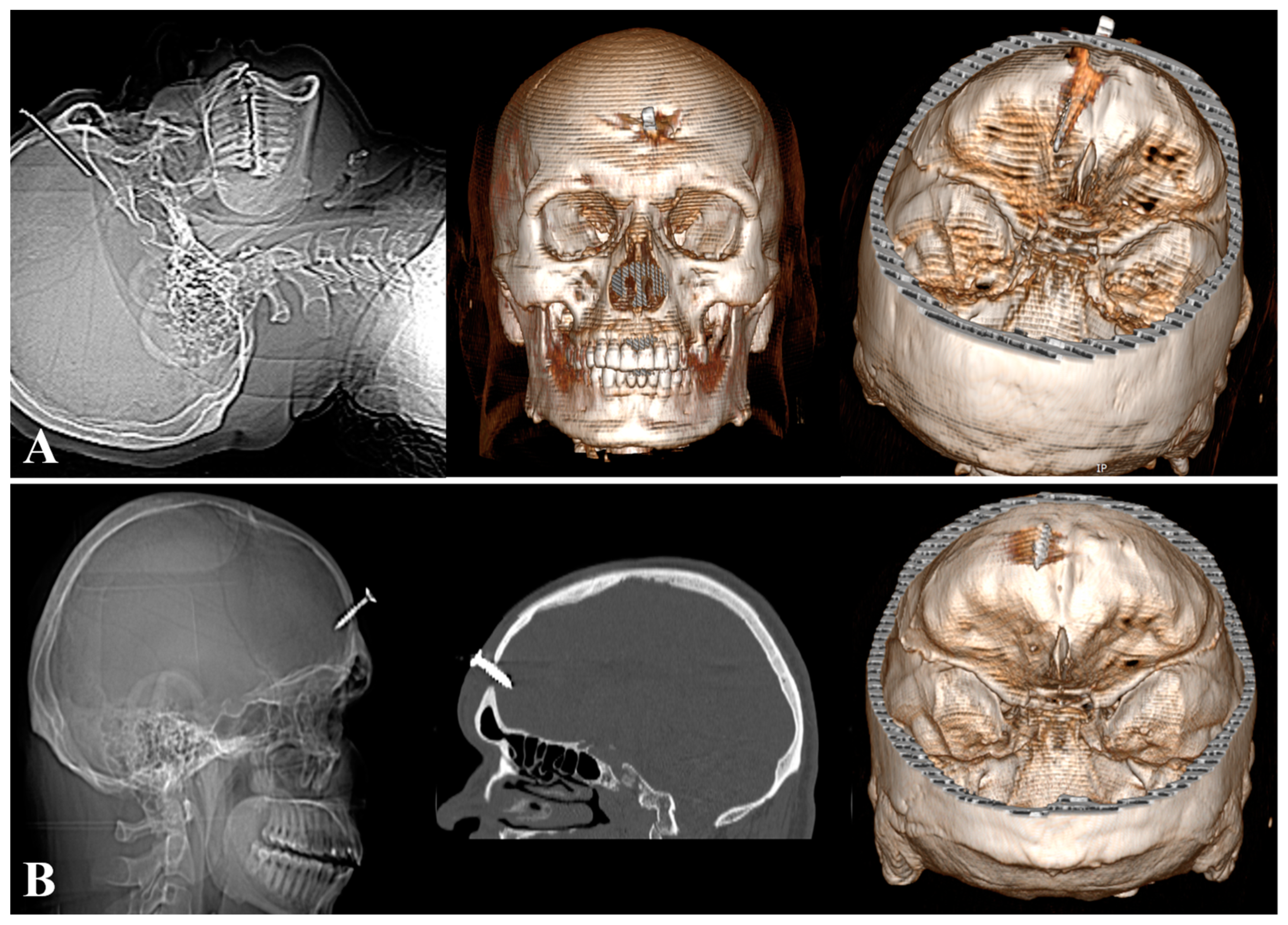 Repetitive Self-Inflicted Craniocerebral Injury in a Patient