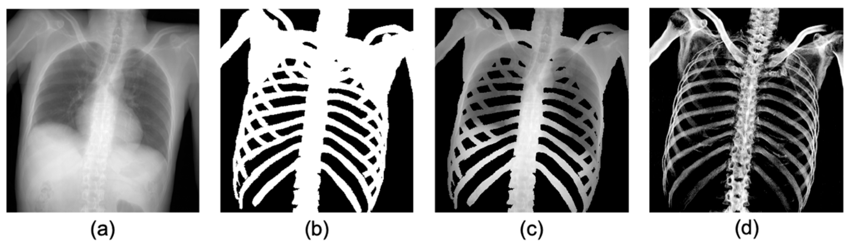 Gray-Scale Extraction of Bone Features from Chest Radiographs Based on ...