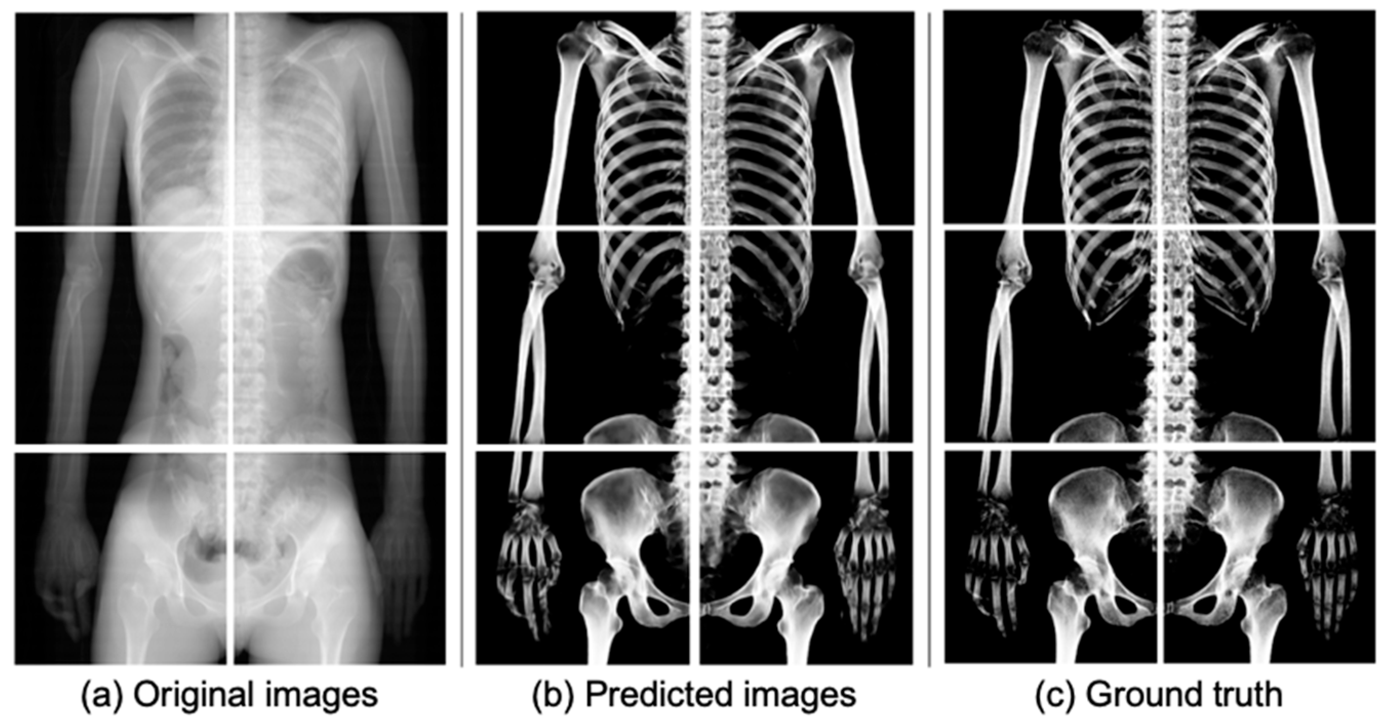 Gray-Scale Extraction of Bone Features from Chest Radiographs Based on ...