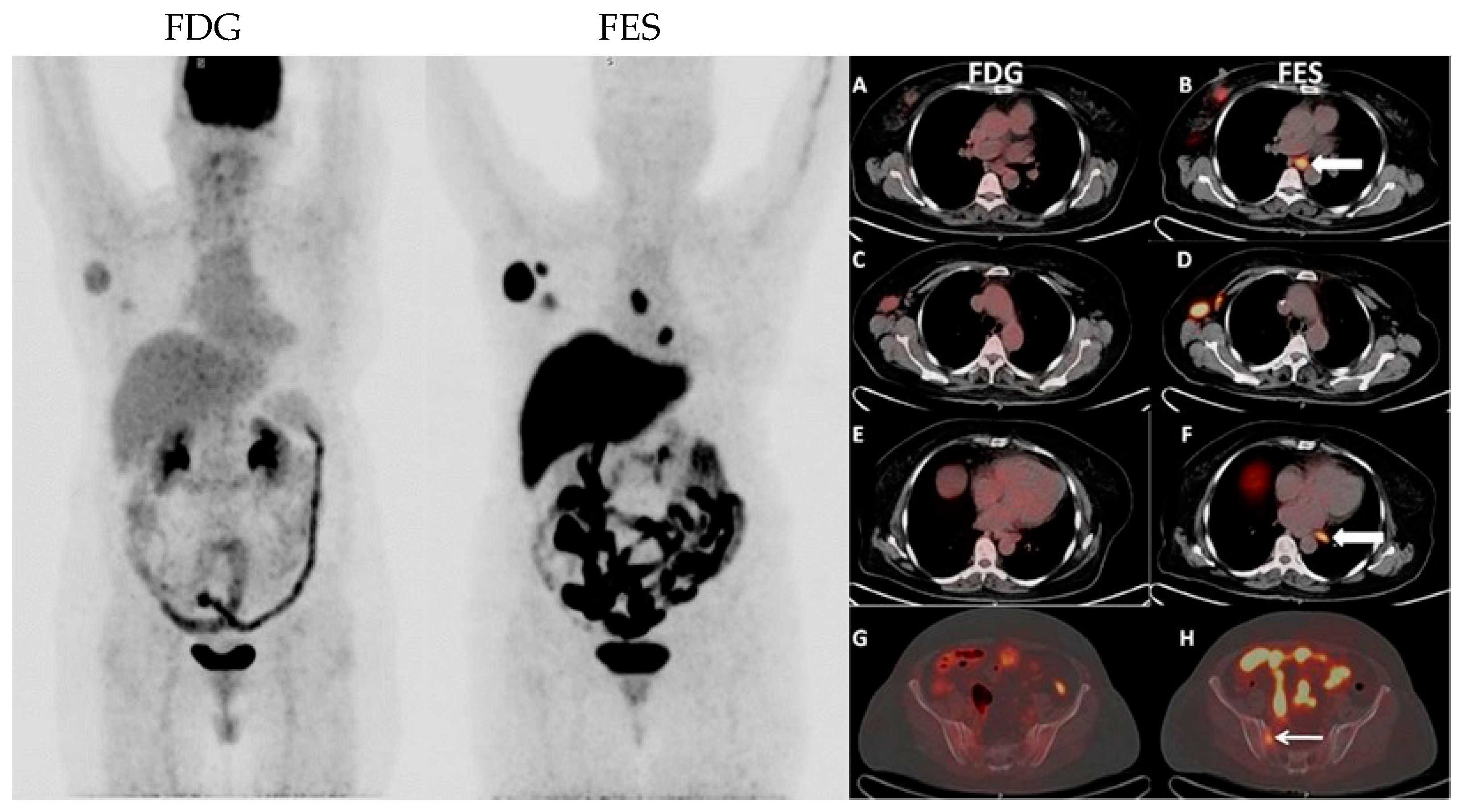 Radiotracer Innovations in Breast Cancer Imaging: A Review