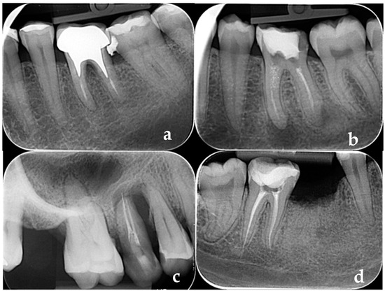 Assessment of Periodontitis Risk Factors in Endodontically